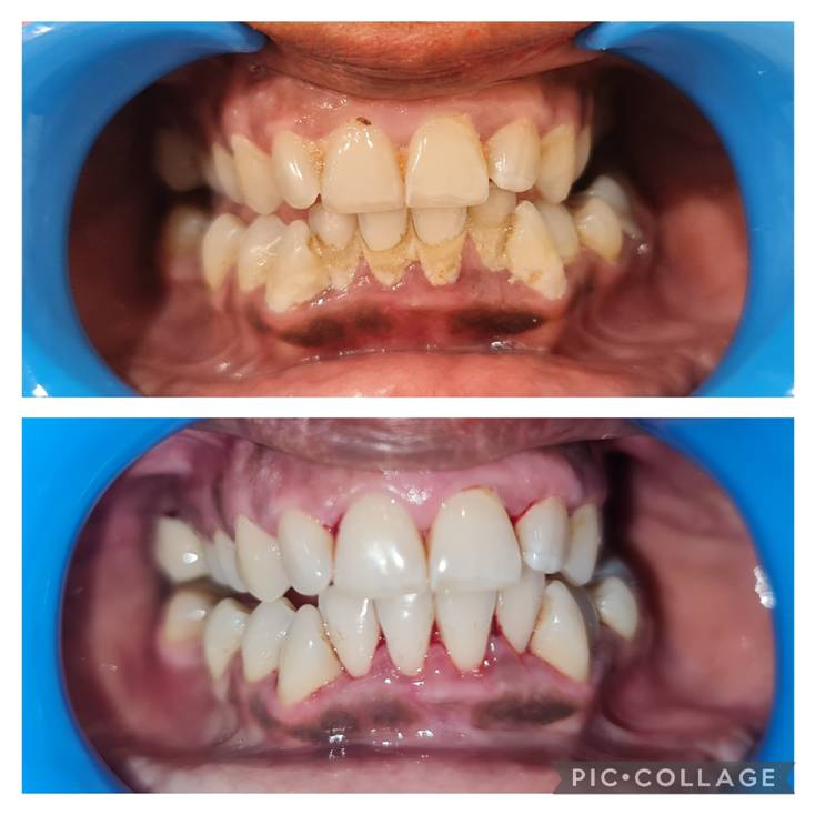 Teeth Whitening